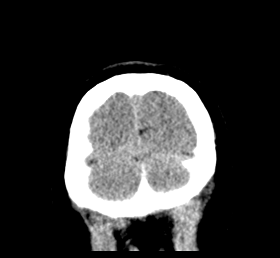 Cerebellar metastases - colorectal adenocarcinoma (Radiopaedia 40947-43652 Coronal non-contrast 86).png