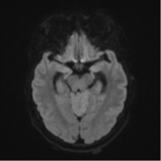 Cerebellar metastasis (Radiopaedia 51137-56765 Axial DWI 40).png