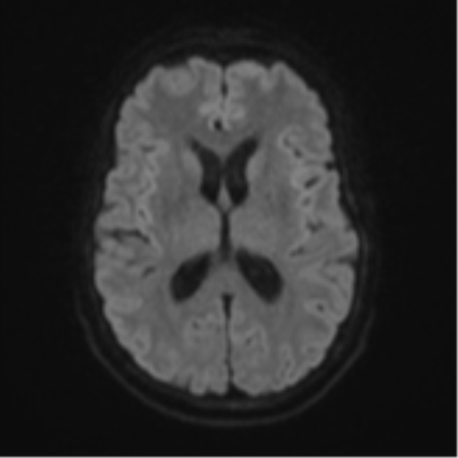 Cerebellar metastasis (Radiopaedia 51137-56765 Axial DWI 44).png