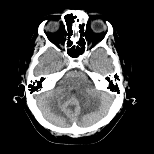 Cerebellar metastasis (Radiopaedia 54578-60812 Axial non-contrast 13).png
