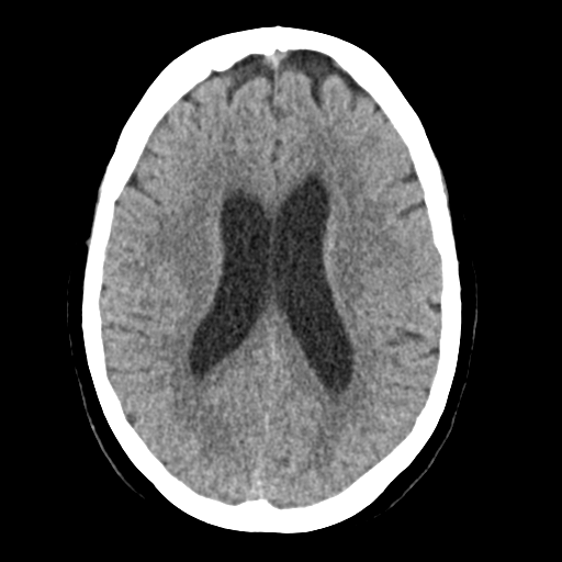 File:Cerebellar metastasis (Radiopaedia 54578-60812 Axial non-contrast 30).png