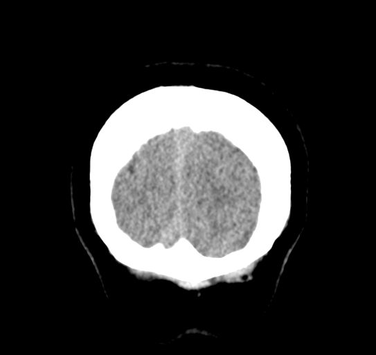 Cerebellar metastasis (Radiopaedia 54578-60812 Coronal non-contrast 57).png