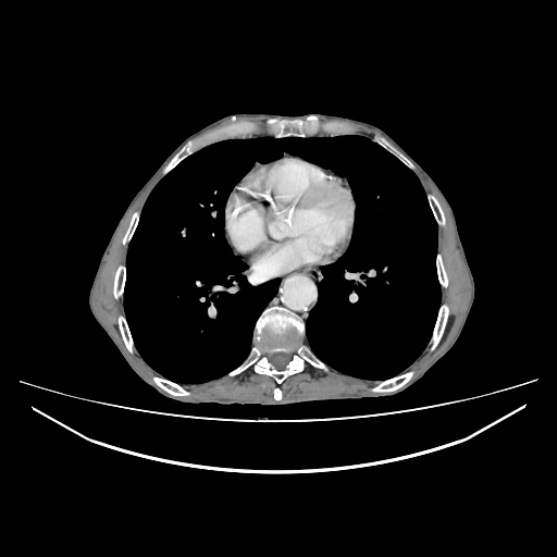 File:Cerebellar metastasis - lung tumor (Radiopaedia 69317-79150 A 23).jpg