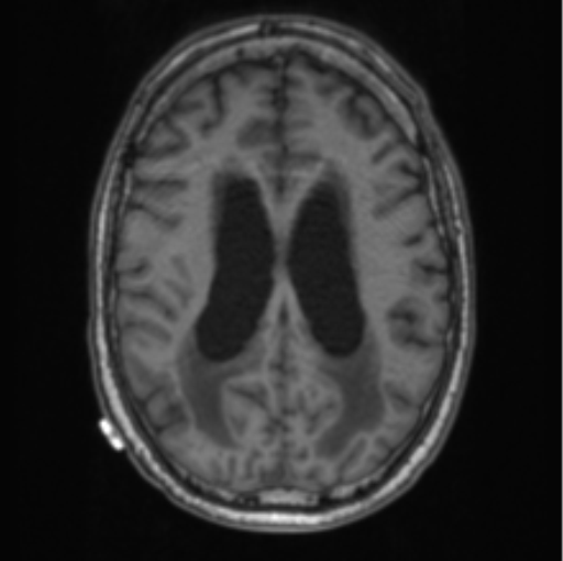 Cerebellar metastasis from lung adenocarcinoma (Radiopaedia 86690-102829 Axial T1 53).png