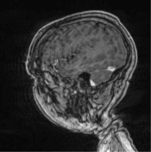 File:Cerebellar metastasis from lung adenocarcinoma (Radiopaedia 86690-102829 Sagittal T1 C+ 18).png