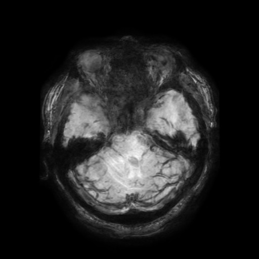 Cerebellar metastasis of pulmonary adenocarcinoma, cavernous venous malformation, and developmental venous anomaly (Radiopaedia 85827-101661 Axial SWI 49).jpg