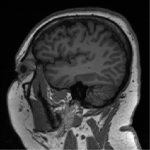 Cerebellopontine angle meningioma (Radiopaedia 48434-53348 Sagittal T1 24).png