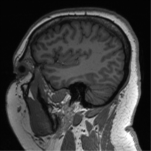 File:Cerebellopontine angle meningioma (Radiopaedia 48434-53348 Sagittal T1 69).png
