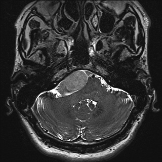 Cerebellopontine angle meningioma (Radiopaedia 72983-83680 Axial FIESTA 18).jpg