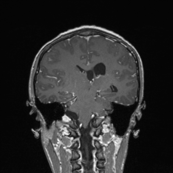 File:Cerebral abscess (Radiopaedia 24212-24478 Coronal T1 C+ 127).jpg
