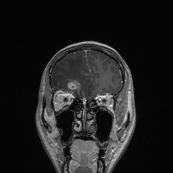 Cerebral abscess (Radiopaedia 24212-24478 Coronal T1 C+ 57).jpg