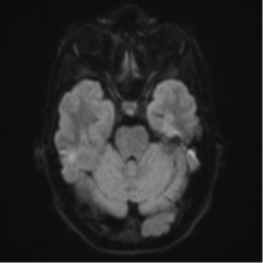 File:Cerebral abscess (Radiopaedia 60342-68009 Axial DWI 47).png