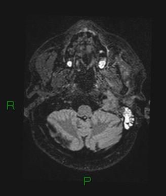 Cerebral abscess and subdural empyema (Radiopaedia 84436-99779 Axial FLAIR 71).jpg