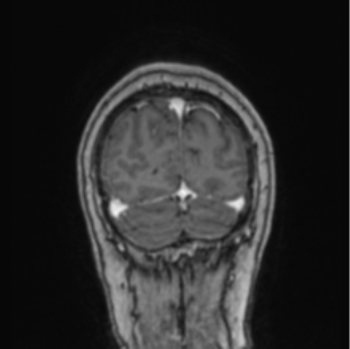 Cerebral abscess from pulmonary arteriovenous malformation (Radiopaedia 86275-102291 L 16).png