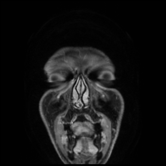 Cerebral abscess with ventriculitis (Radiopaedia 78965-91878 Coronal T1 C+ 5).jpg