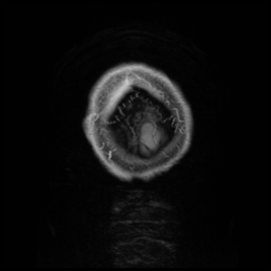 Cerebral abscess with ventriculitis (Radiopaedia 78965-91878 Coronal T1 C+ 64).jpg