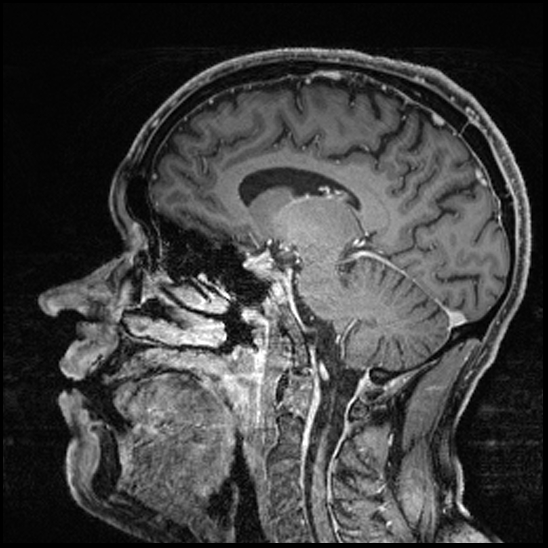 Cerebral abscess with ventriculitis (Radiopaedia 78965-91878 Sagittal T1 C+ 103).jpg