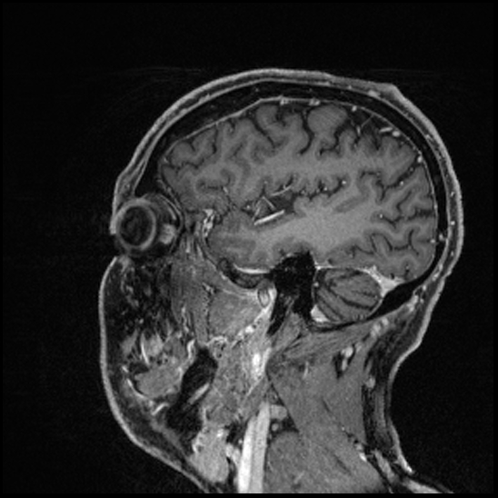 Cerebral abscess with ventriculitis (Radiopaedia 78965-91878 Sagittal T1 C+ 139).jpg