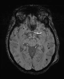Cerebral amyloid angiopathy-related inflammation (Radiopaedia 74836-85849 Axial SWI 32).jpg