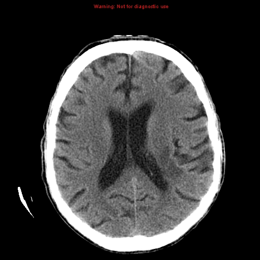 File:Cerebral and orbital tuberculomas (Radiopaedia 13308-13310 Axial non-contrast 36).jpg