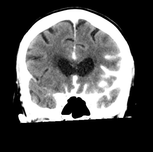 File:Cerebral aneurysm with rupture (Radiopaedia 29933-30460 Coronal non-contrast 13).jpg