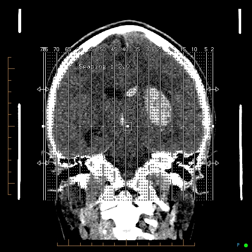 Cerebral arteriovenous malformation (AVM) (Radiopaedia 78162-90706 A 1).jpg