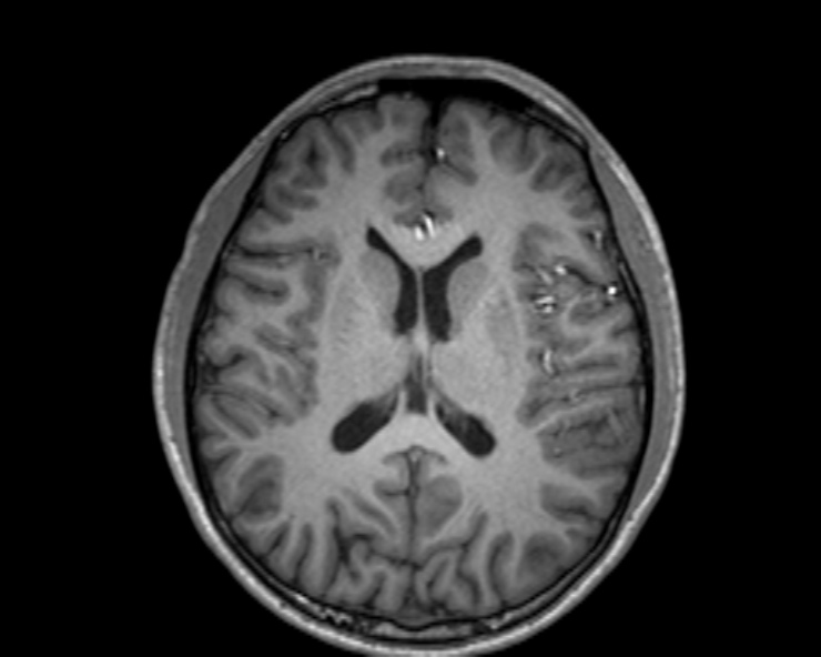 Cerebral arteriovenous malformation (Radiopaedia 30198-30813 Axial T1 30).jpg
