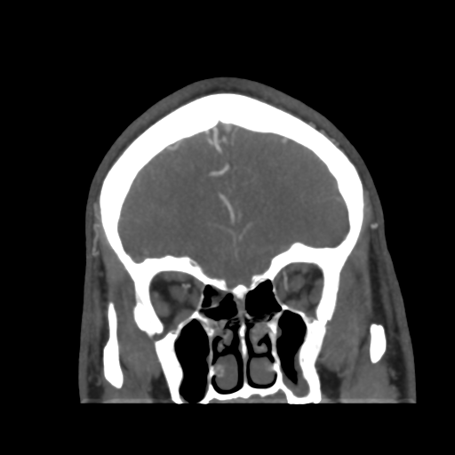 Cerebral arteriovenous malformation (Radiopaedia 39259-41505 E 15).png