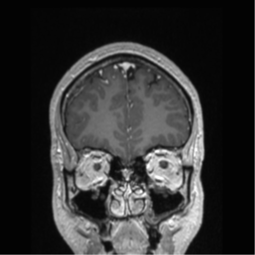 Cerebral arteriovenous malformation (Radiopaedia 39259-41506 Coronal T1 C+ 76).png