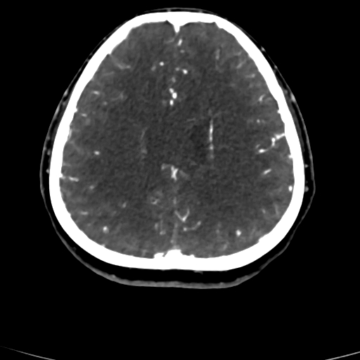 Cerebral arteriovenous malformation (Radiopaedia 73830-84645 Axial C+ delayed 29).jpg
