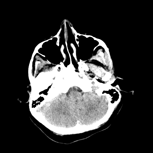 File:Cerebral arteriovenous malformation (Radiopaedia 73830-84645 Axial non-contrast 8).jpg