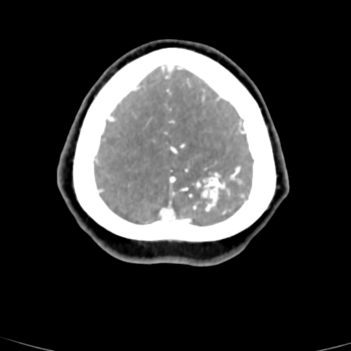 Cerebral arteriovenous malformation (Radiopaedia 73830-84645 B 14).jpg