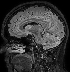 Cerebral arteriovenous malformation (Radiopaedia 74411-85654 Sagittal FLAIR 53).jpg