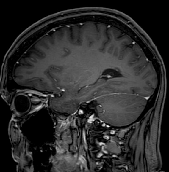 Cerebral arteriovenous malformation (Radiopaedia 74411-85746 Sagittal T1 C+ 39).jpg