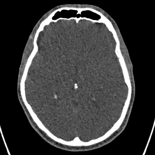 Cerebral arteriovenous malformation (Radiopaedia 78188-90746 Axial non-contrast 86).jpg