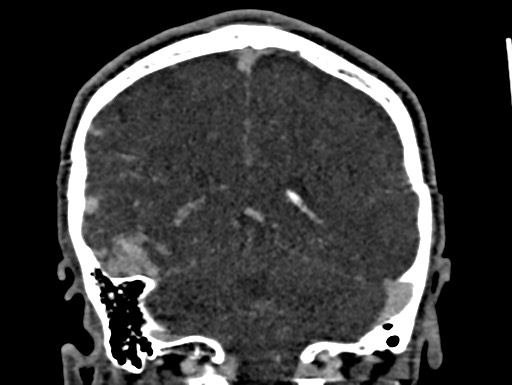 Cerebral arteriovenous malformation (Radiopaedia 78188-90746 Coronal C+ delayed 83).jpg
