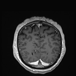 Cerebral arteriovenous malformation (Radiopaedia 84015-99245 Coronal T1 C+ 138).jpg