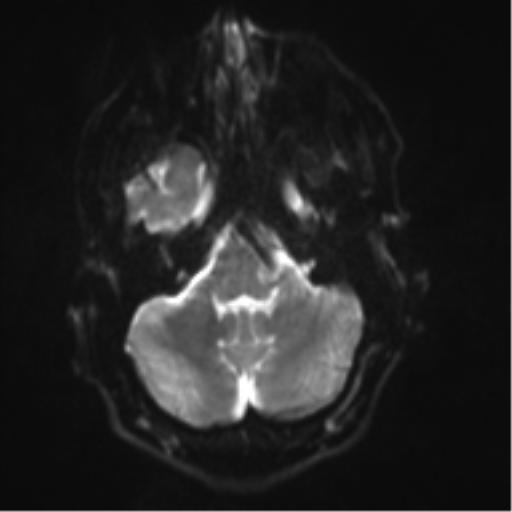File:Cerebral arteriovenous malformation - huge (Radiopaedia 35734-37272 Axial DWI 5).png