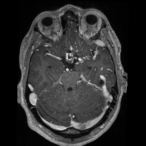 Cerebral arteriovenous malformation - huge (Radiopaedia 35734-37272 Axial T1 C+ 23).png