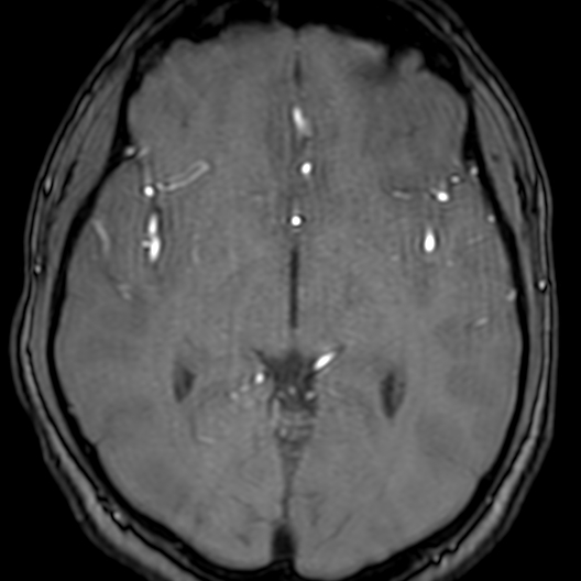 Cerebral arteriovenous malformation at posterior body of corpus callosum (Radiopaedia 74111-84925 Axial MRA 99).jpg