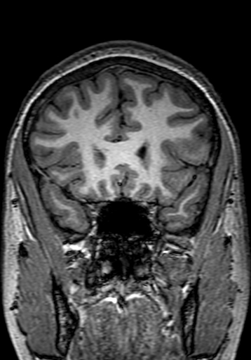 Cerebral arteriovenous malformation at posterior body of corpus callosum (Radiopaedia 74111-84925 Coronal T1 90).jpg