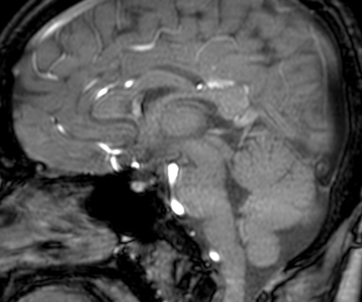 Cerebral arteriovenous malformation at posterior body of corpus callosum (Radiopaedia 74111-84925 J 192).jpg