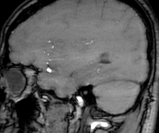 Cerebral arteriovenous malformation at posterior body of corpus callosum (Radiopaedia 74111-84925 J 96).jpg