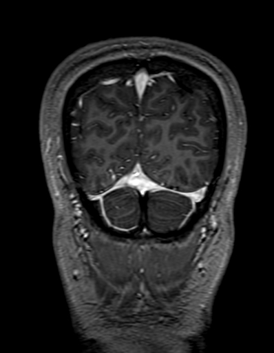 Cerebral arteriovenous malformation at posterior body of corpus callosum (Radiopaedia 74111-84925 K 335).jpg