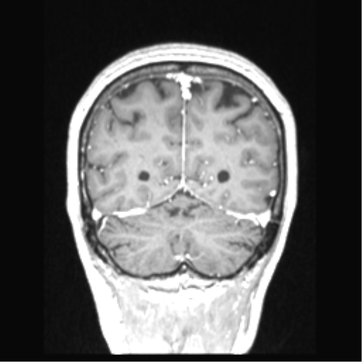 Cerebral arteriovenous malformation with hemorrhage (Radiopaedia 34422-35737 Coronal T1 C+ 23).png