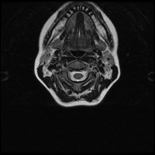 Cerebral autosomal dominant arteriopathy with subcortical infarcts and leukoencephalopathy (CADASIL) (Radiopaedia 41018-43763 Ax T2 C2-T1 31).png