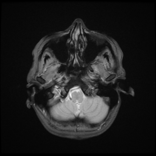 File:Cerebral autosomal dominant arteriopathy with subcortical infarcts and leukoencephalopathy (CADASIL) (Radiopaedia 41018-43768 Ax 2D MERGE 3).png