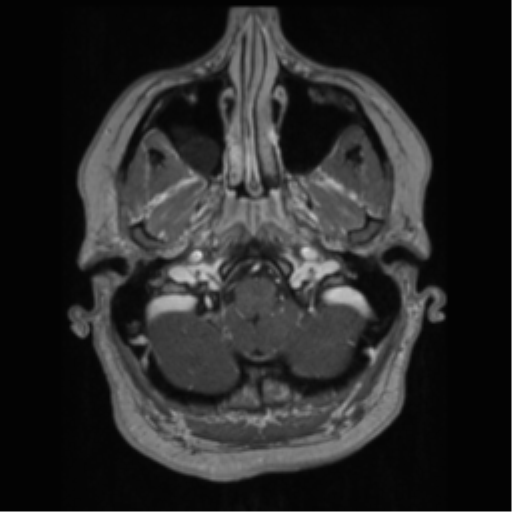 File:Cerebral cavernoma and development venous anomaly (Radiopaedia 37603-39482 Axial T1 C+ 12).png