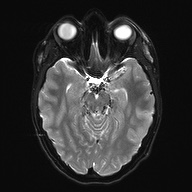 File:Cerebral cavernous venous malformation (Radiopaedia 70008-80021 Axial DWI 12).jpg