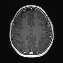 Cerebral cavernous venous malformation (Radiopaedia 70008-80021 Axial T1 C+ 62).jpg